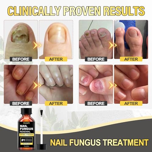 Toenail Fungus Treatment Extra Strength 30ml Z725749